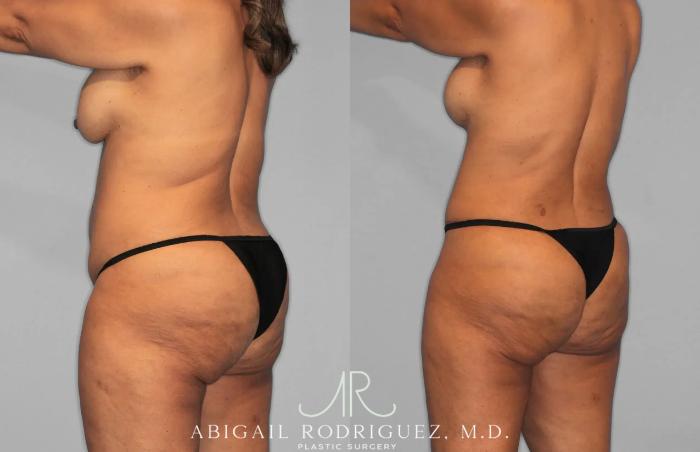 Before & After Tummy Tuck Case 259562 View 5 View in Houston, TX