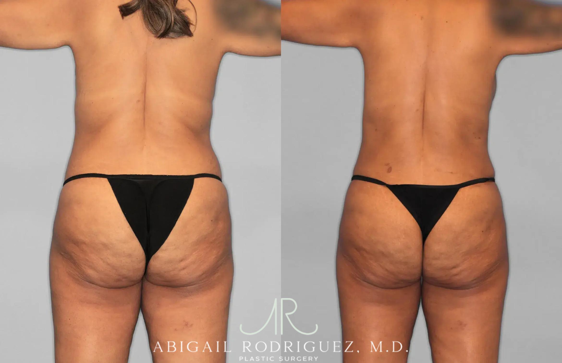 Before & After Tummy Tuck Case 259562 View 6 View in Houston, TX