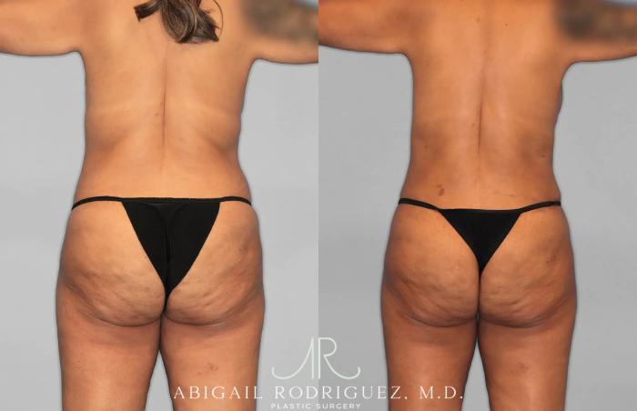 Before & After Tummy Tuck Case 259562 View 6 View in Houston, TX