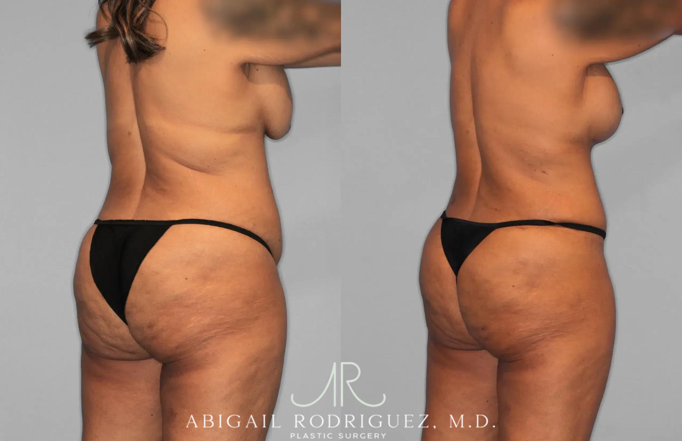 Before & After Tummy Tuck Case 259562 View 7 View in Houston, TX