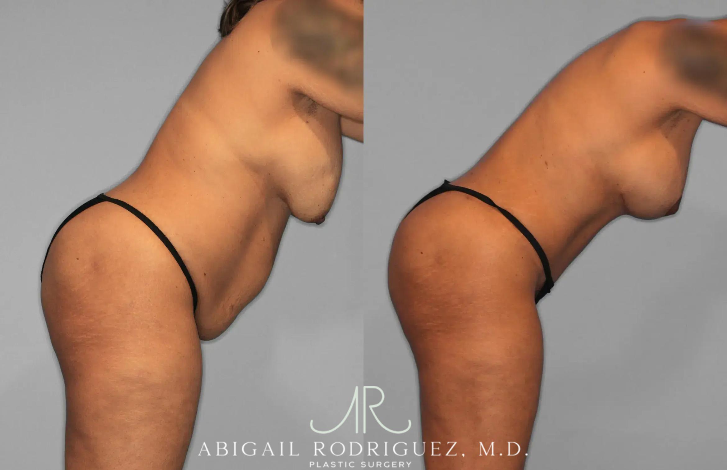 Before & After Tummy Tuck Case 259562 View 8 View in Houston, TX