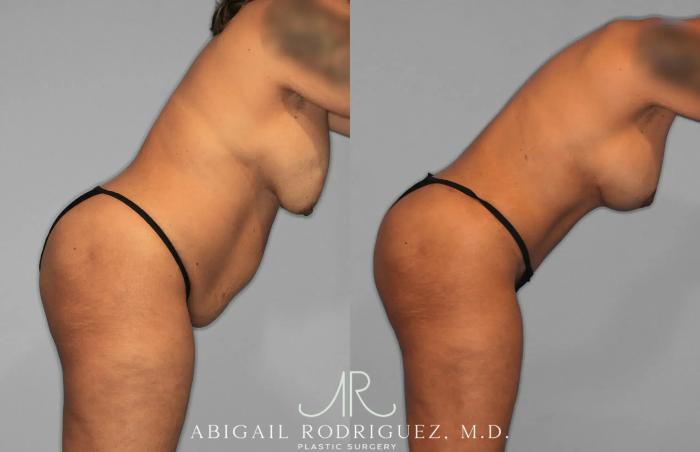 Before & After Tummy Tuck Case 259562 View 8 View in Houston, TX