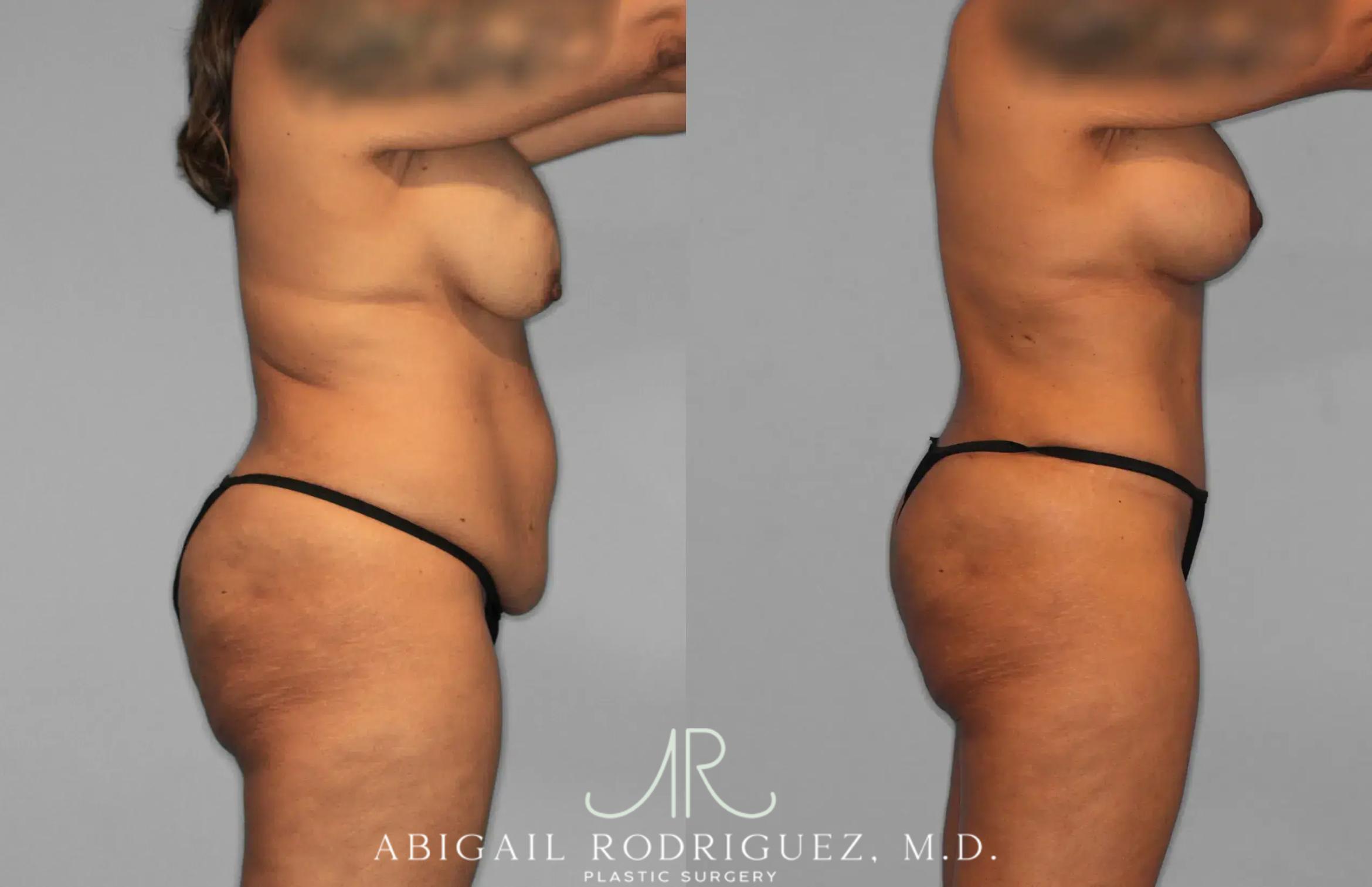 Before & After Tummy Tuck Case 259562 View 9 View in Houston, TX