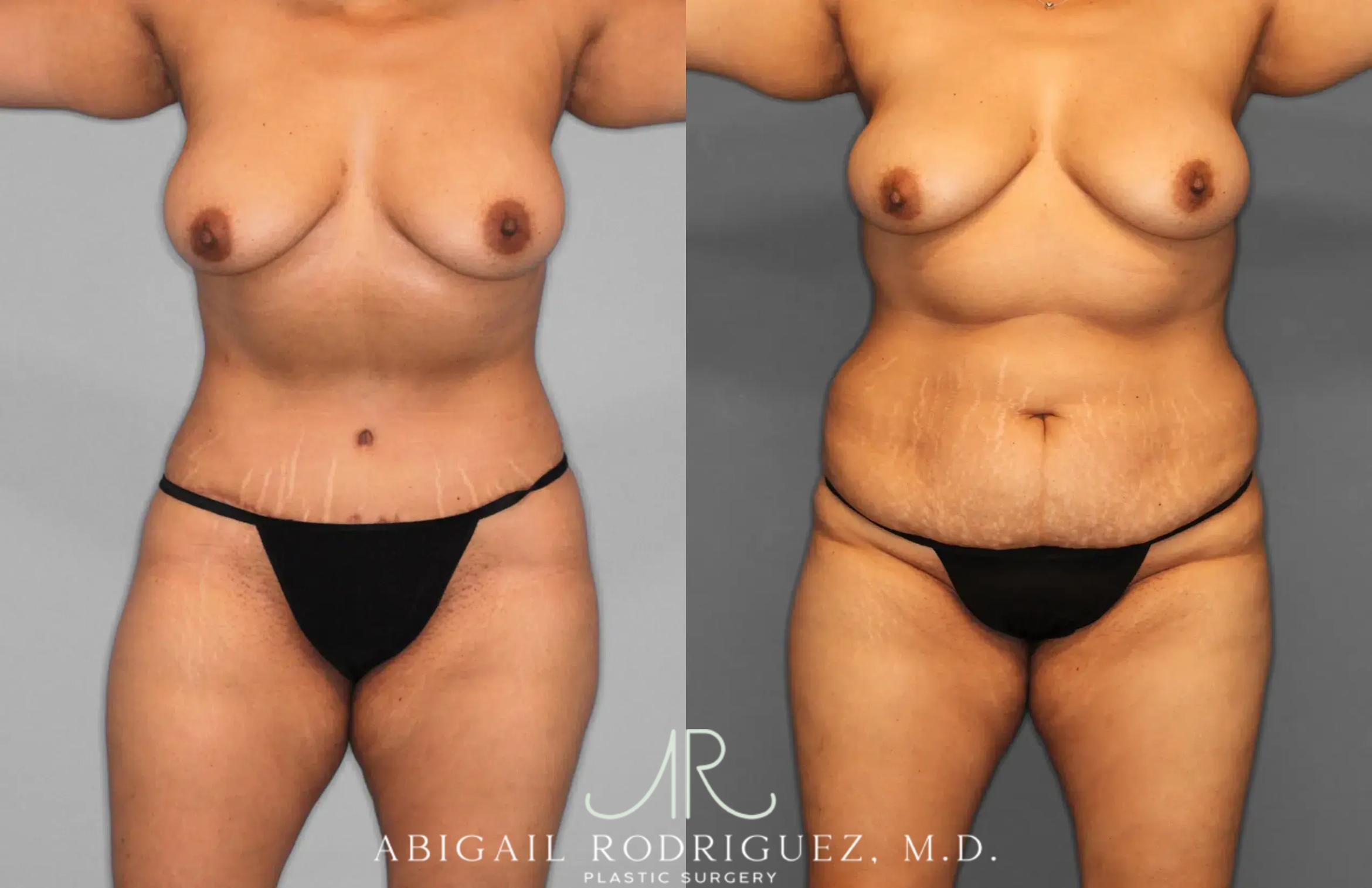 Before & After Tummy Tuck Case 259597 View 1 View in Houston, TX