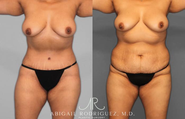 Before & After Tummy Tuck Case 259597 View 1 View in Houston, TX