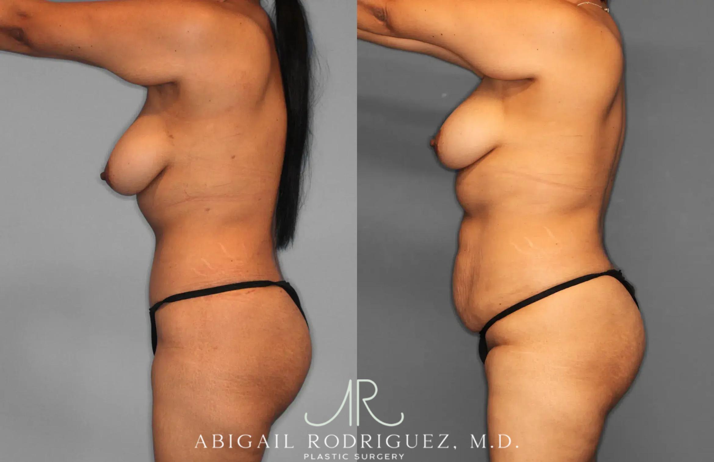 Before & After Tummy Tuck Case 259597 View 2 View in Houston, TX