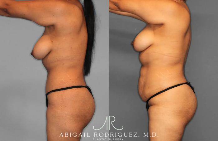 Before & After Tummy Tuck Case 259597 View 2 View in Houston, TX