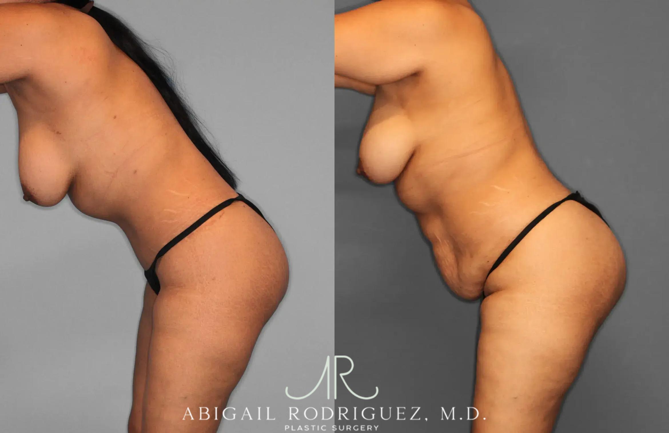 Before & After Tummy Tuck Case 259597 View 3 View in Houston, TX