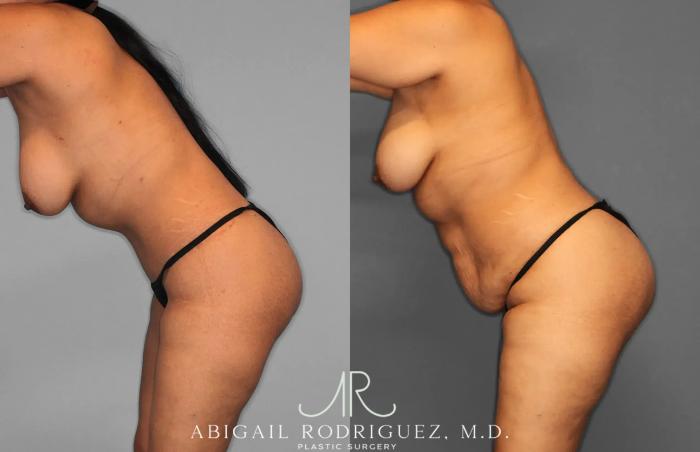 Before & After Tummy Tuck Case 259597 View 3 View in Houston, TX