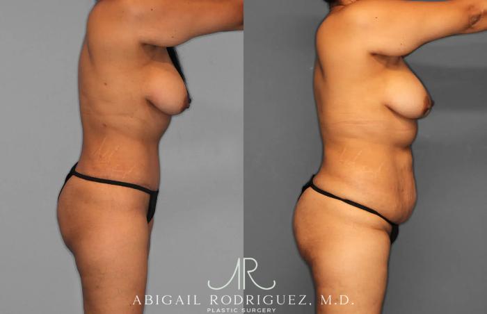 Before & After Tummy Tuck Case 259597 View 4 View in Houston, TX