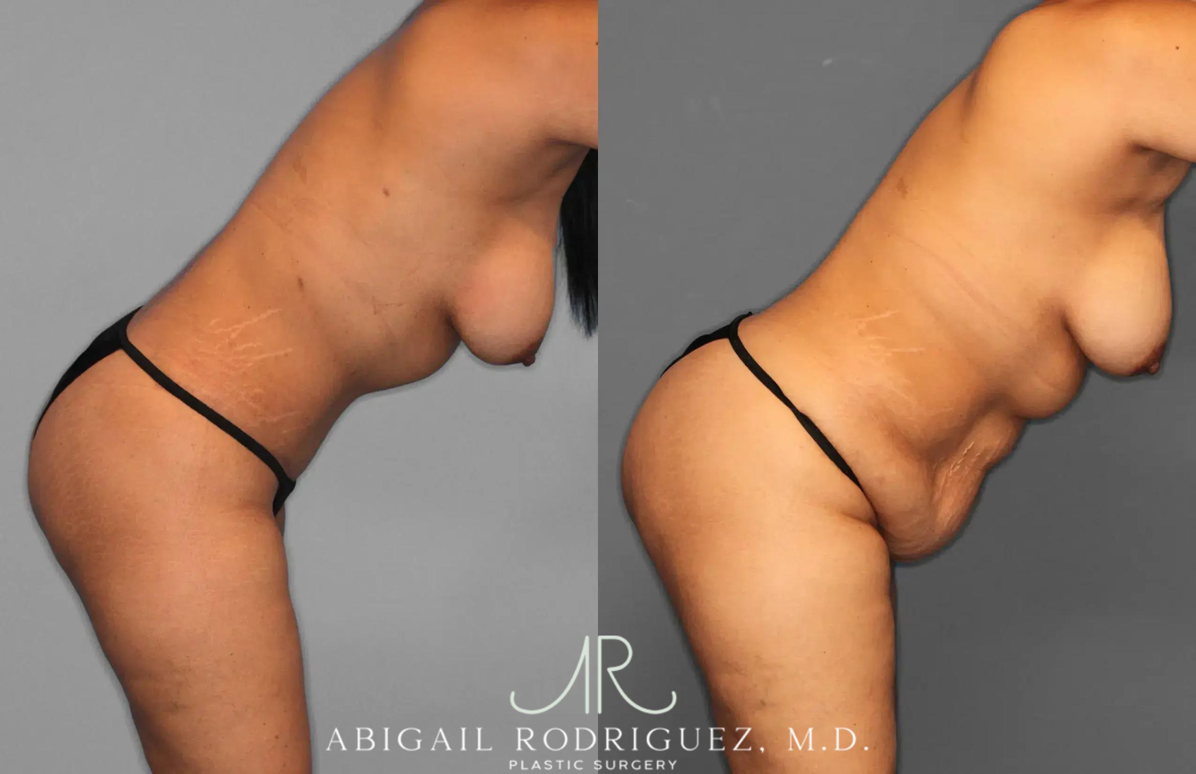 Before & After Tummy Tuck Case 259597 View 5 View in Houston, TX