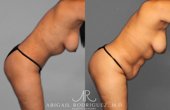 Before & After Tummy Tuck Case 259597 View 5 View in Houston, TX