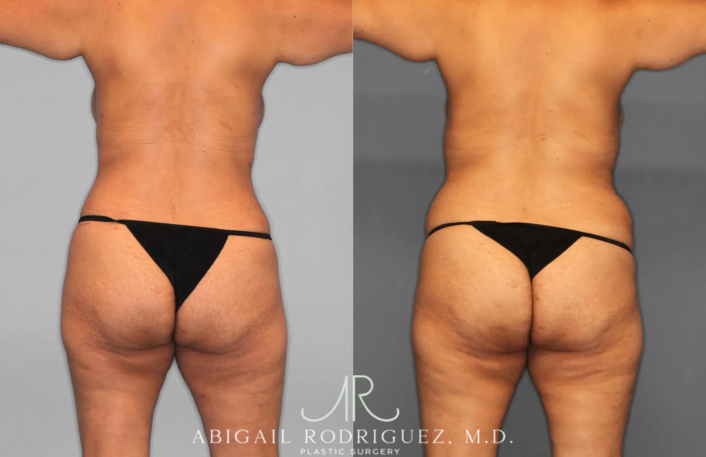 Before & After Tummy Tuck Case 259597 View 6 View in Houston, TX