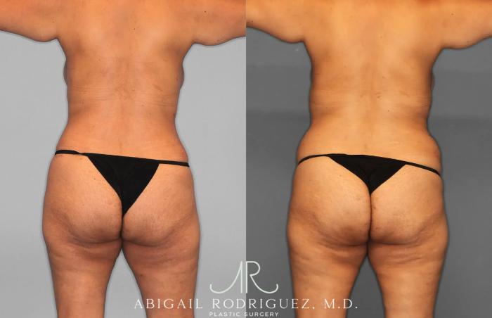 Before & After Tummy Tuck Case 259597 View 6 View in Houston, TX