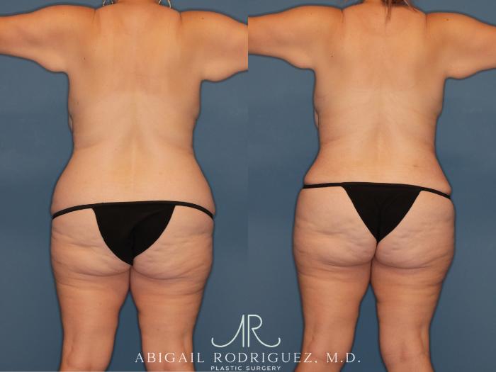 Before & After Tummy Tuck Case 346008 Back View in Houston, TX
