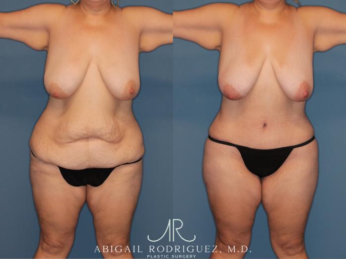 Before & After Tummy Tuck Case 346008 Front View in Houston, TX