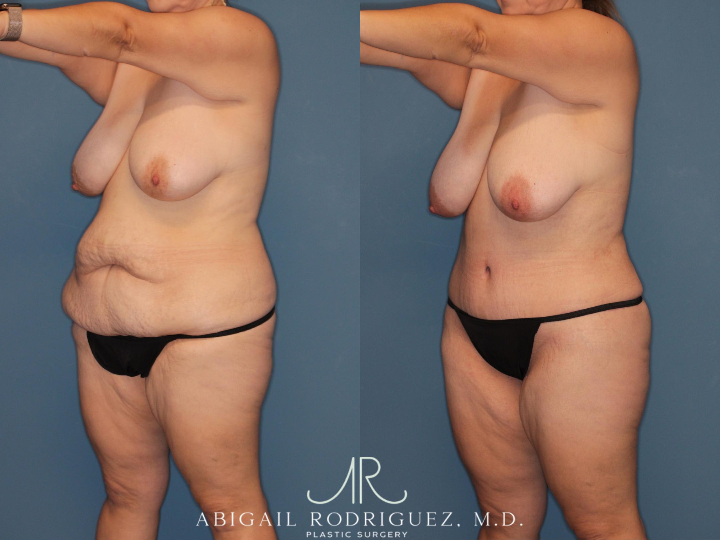 Before & After Tummy Tuck Case 346008 Left Oblique View in Houston, TX