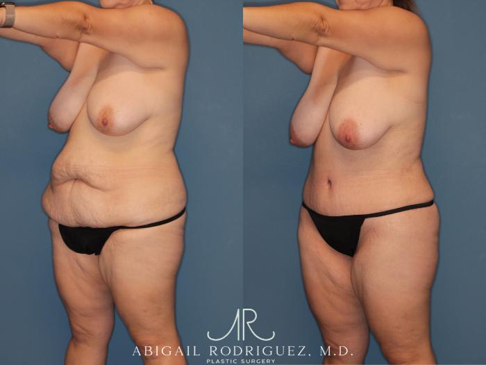 Before & After Tummy Tuck Case 346008 Left Oblique View in Houston, TX