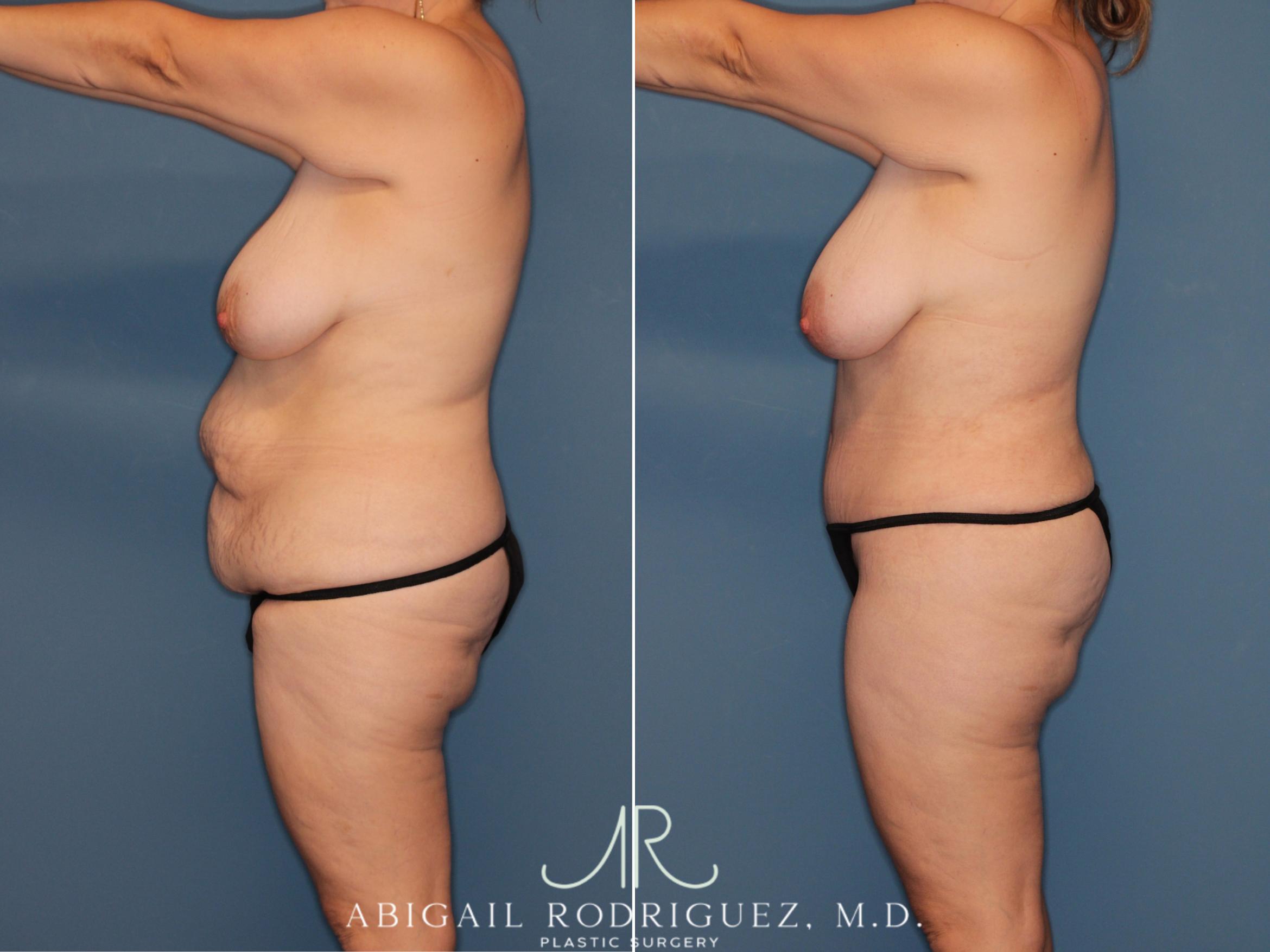 Before & After Tummy Tuck Case 346008 Left Side View in Houston, TX