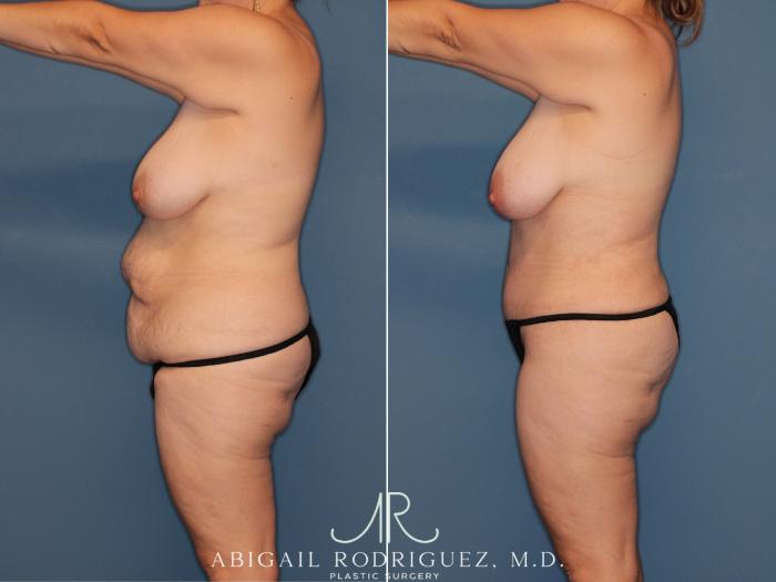 Before & After Tummy Tuck Case 346008 Left Side View in Houston, TX