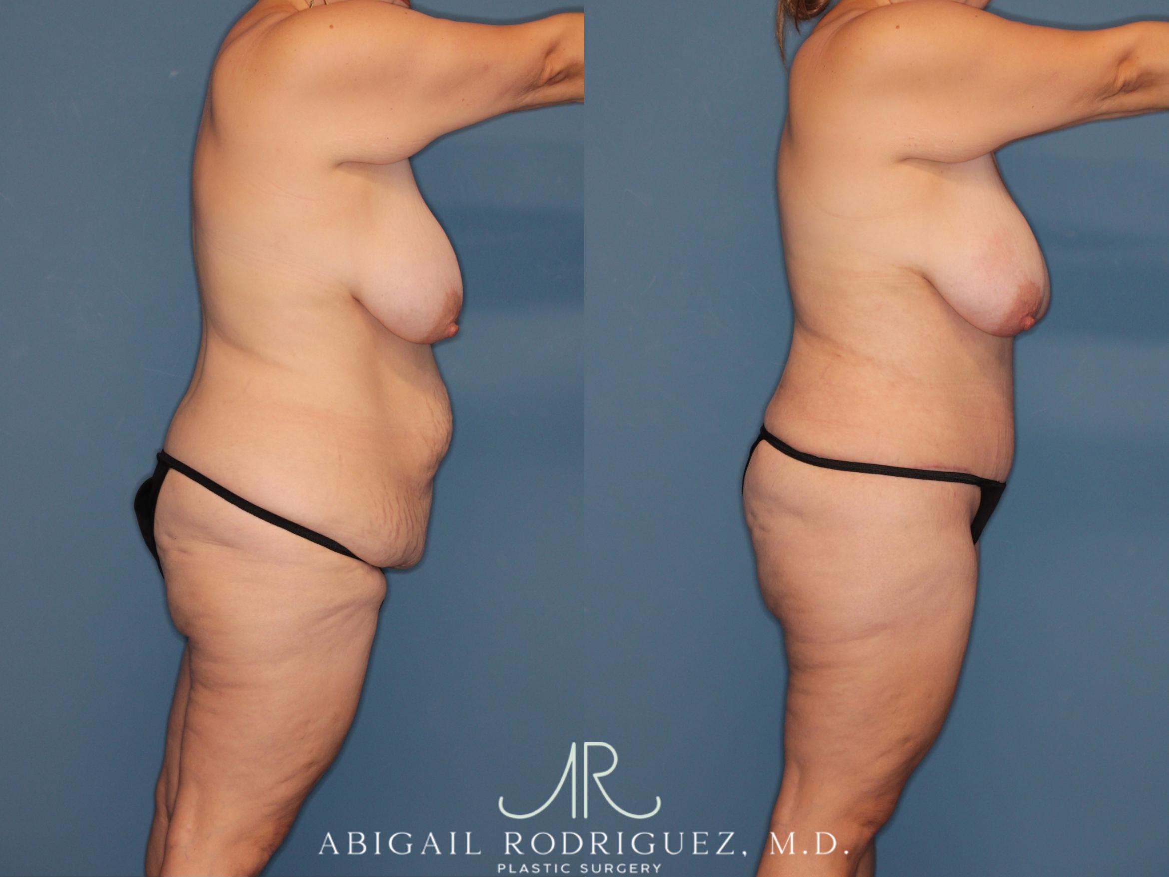 Before & After Tummy Tuck Case 346008 Right Side View in Houston, TX