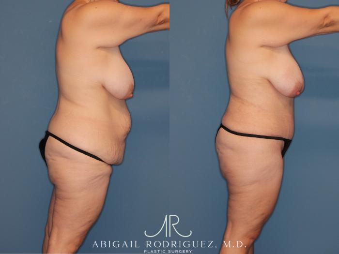Before & After Tummy Tuck Case 346008 Right Side View in Houston, TX