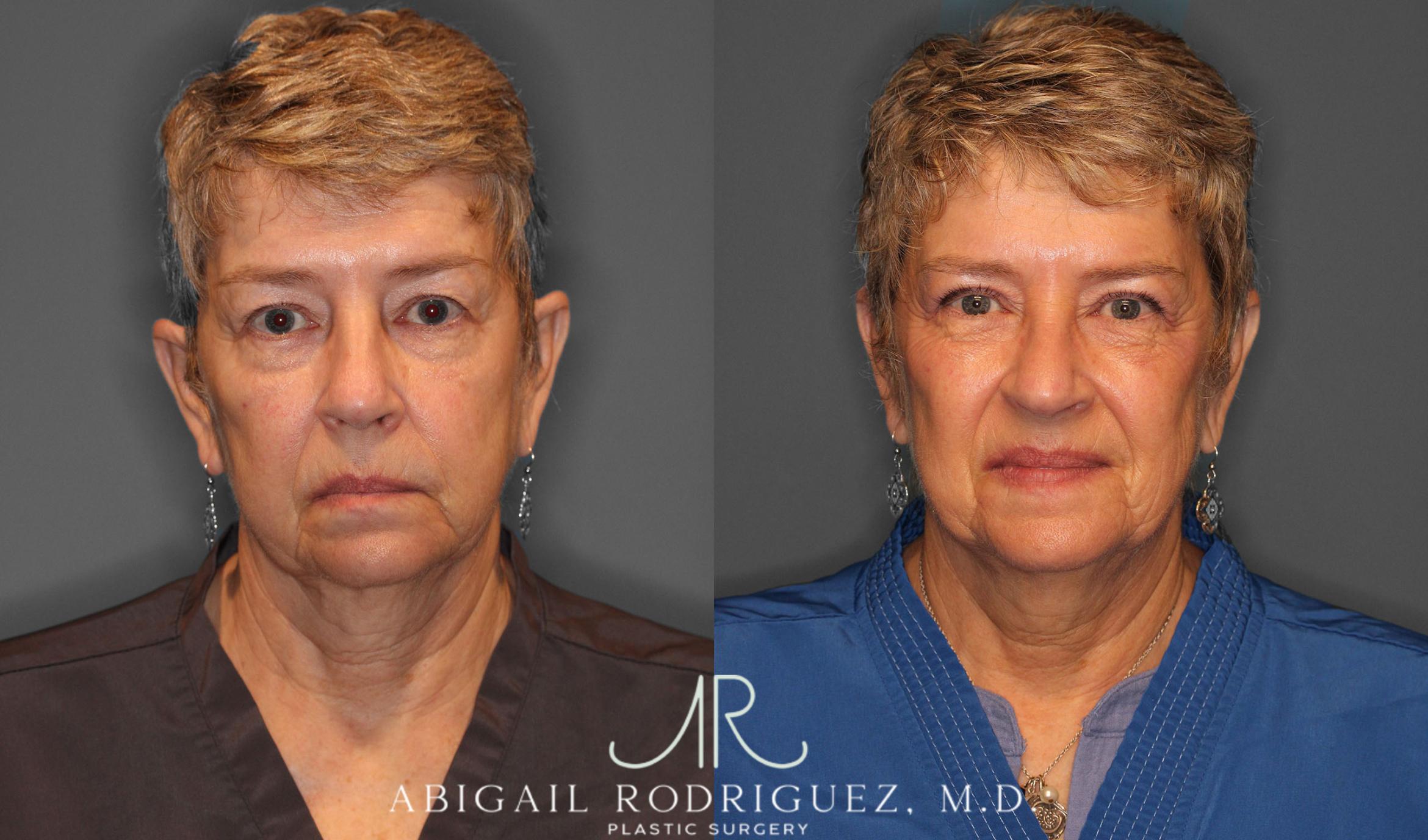 Before & After Upper Eyelid Lift Case 257534 View 1 View in Houston, TX