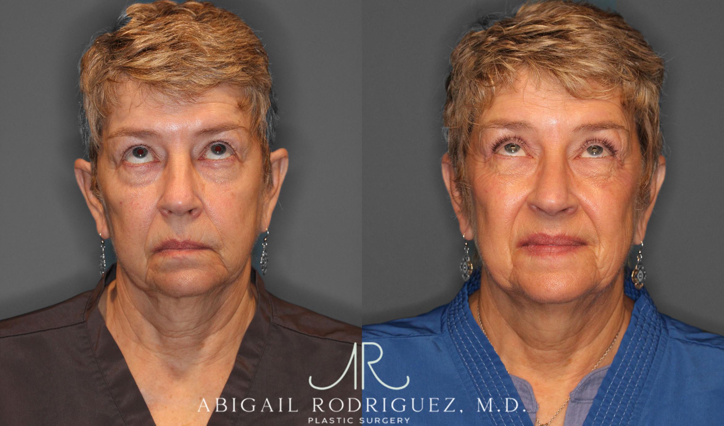 Before & After Upper Eyelid Lift Case 257534 View 2 View in Houston, TX
