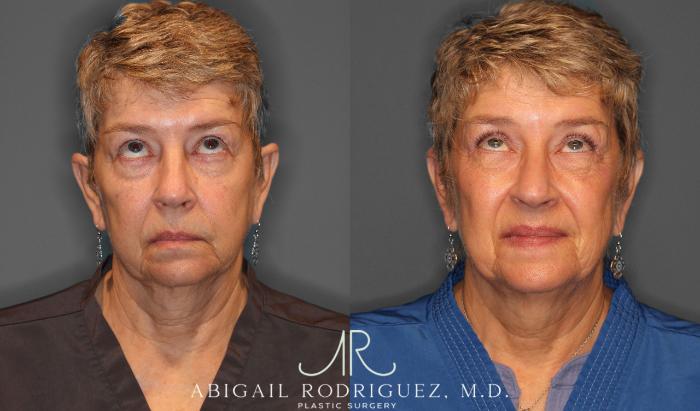 Before & After Upper Eyelid Lift Case 257534 View 2 View in Houston, TX
