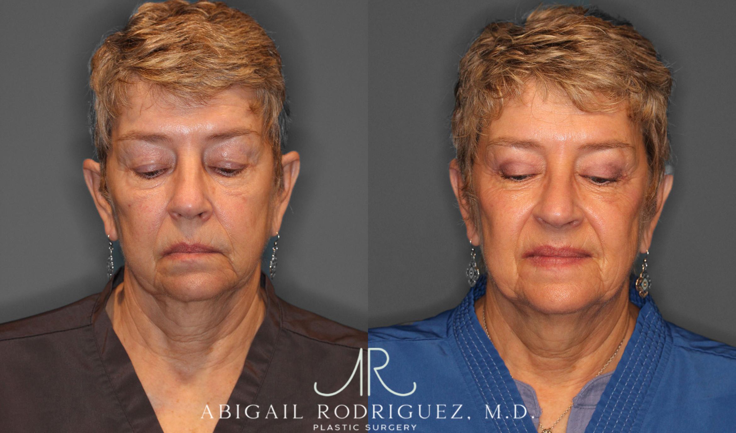 Before & After Upper Eyelid Lift Case 257534 View 3 View in Houston, TX