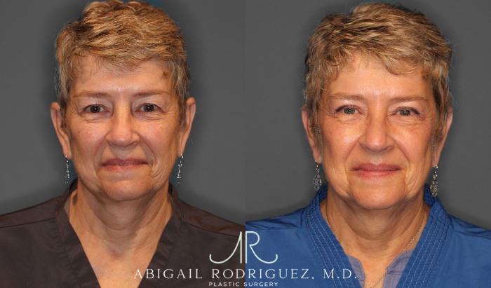 Before & After Upper Eyelid Lift Case 257534 View 4 View in Houston, TX
