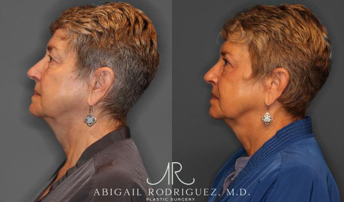 Before & After Upper Eyelid Lift Case 257534 View 5 View in Houston, TX