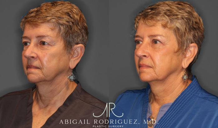 Before & After Upper Eyelid Lift Case 257534 View 6 View in Houston, TX