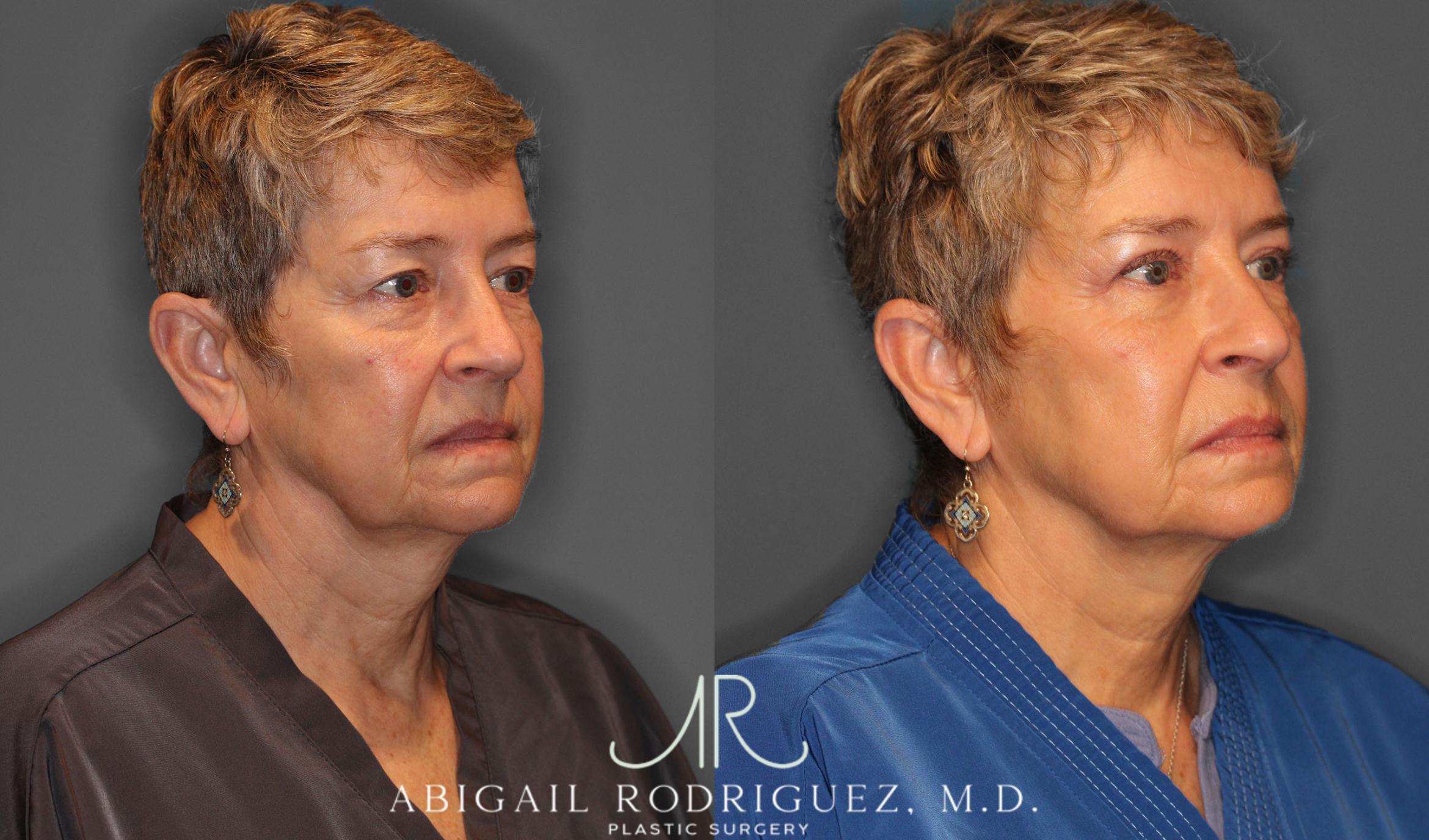 Before & After Upper Eyelid Lift Case 257534 View 7 View in Houston, TX