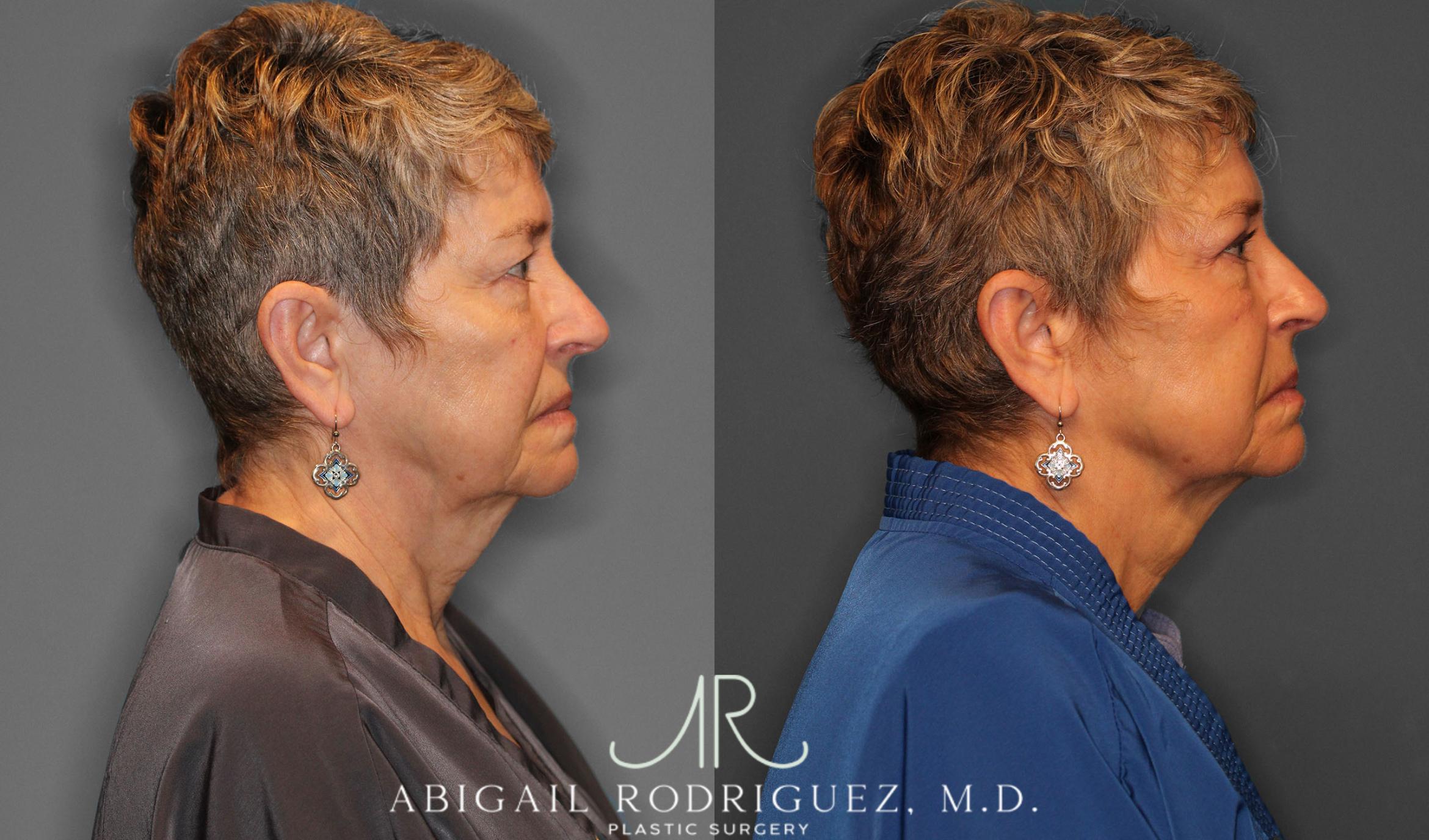 Before & After Upper Eyelid Lift Case 257534 View 8 View in Houston, TX