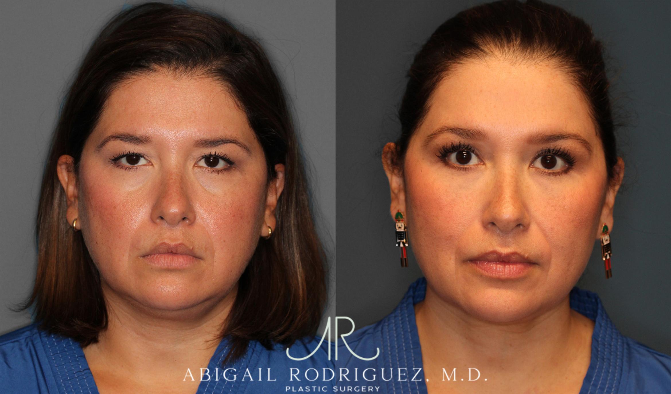 Before & After Upper Eyelid Lift Case 258011 View 1 View in Houston, TX