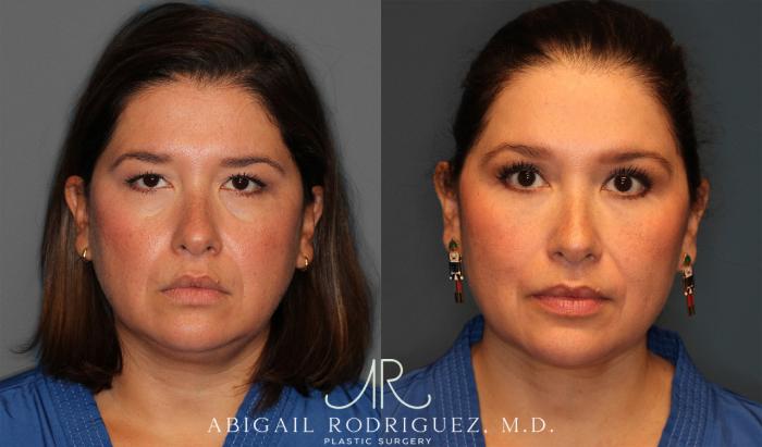 Before & After Upper Eyelid Lift Case 258011 View 1 View in Houston, TX