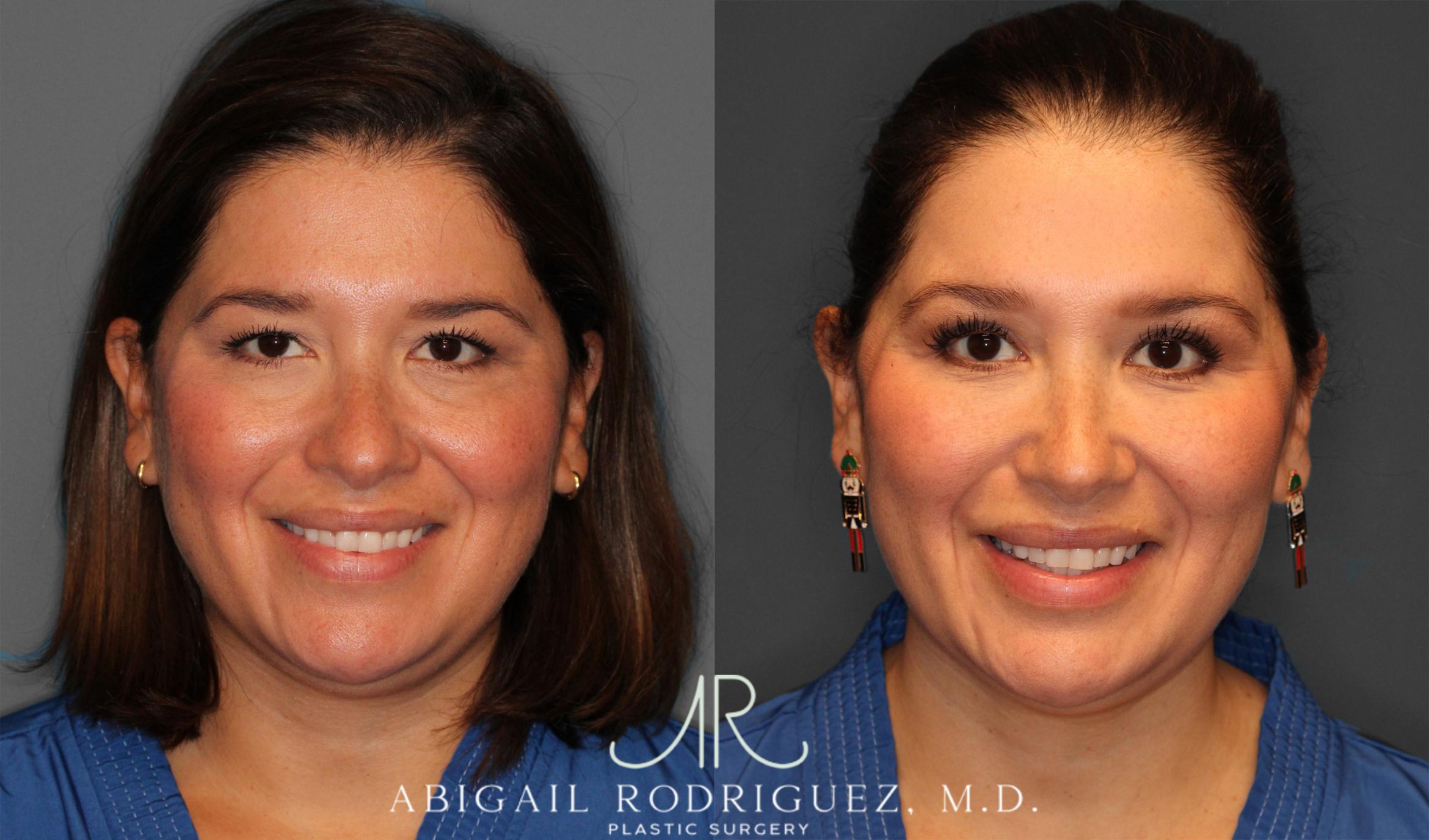 Before & After Upper Eyelid Lift Case 258011 View 2 View in Houston, TX