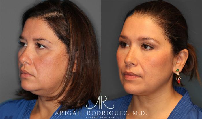 Before & After Upper Eyelid Lift Case 258011 View 3 View in Houston, TX