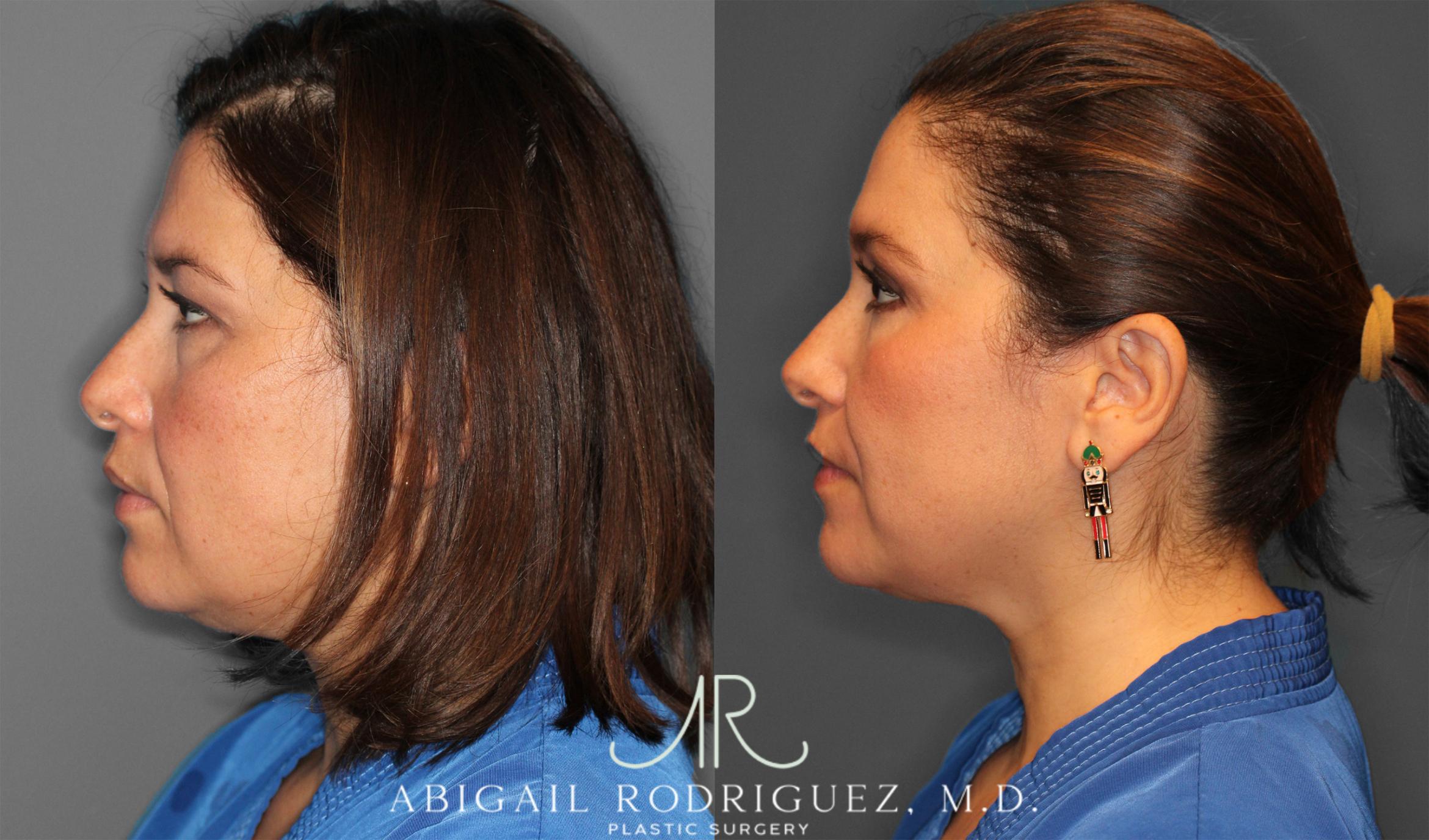 Before & After Upper Eyelid Lift Case 258011 View 4 View in Houston, TX