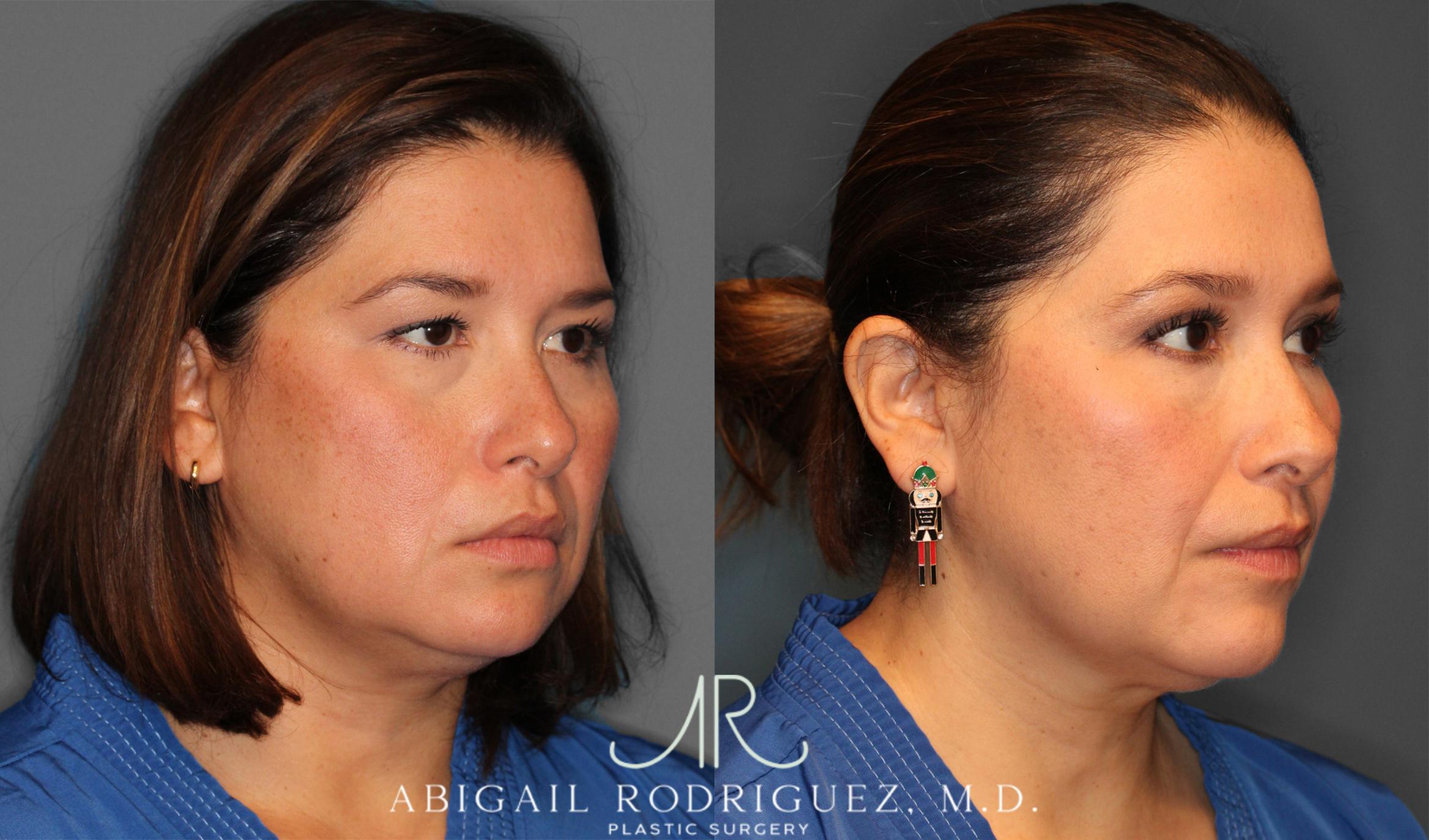 Before & After Upper Eyelid Lift Case 258011 View 5 View in Houston, TX