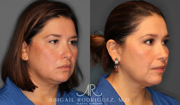 Before & After Upper Eyelid Lift Case 258011 View 5 View in Houston, TX