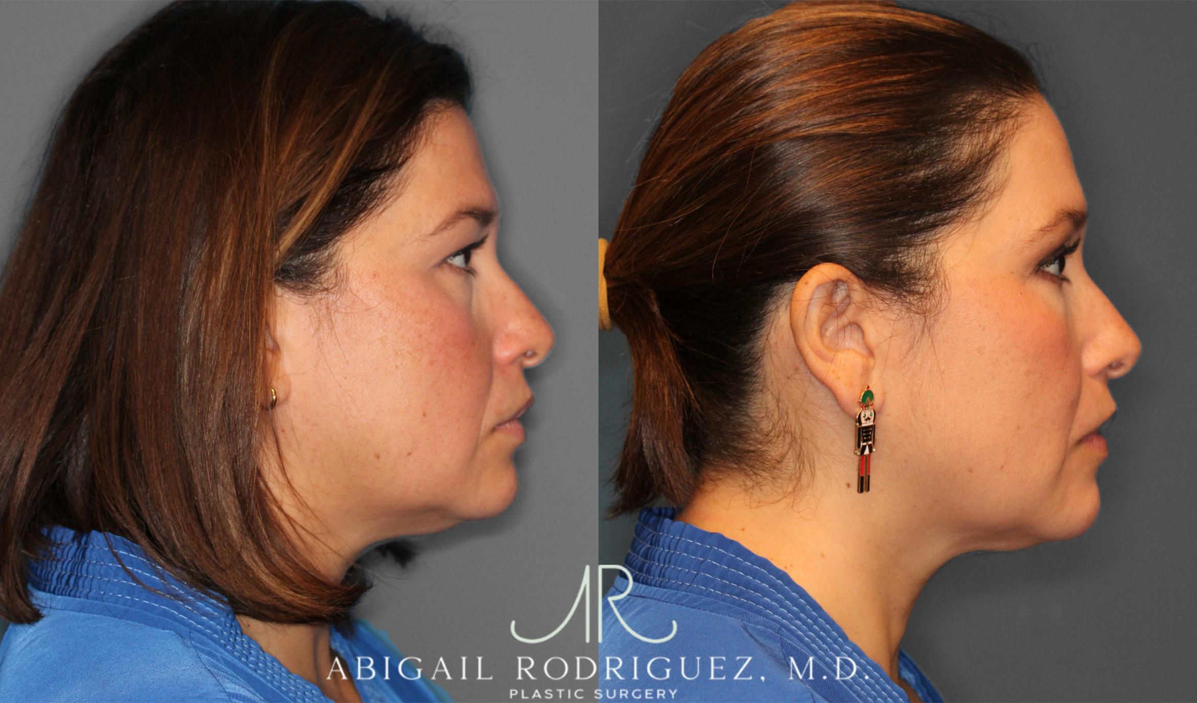 Before & After Upper Eyelid Lift Case 258011 View 6 View in Houston, TX