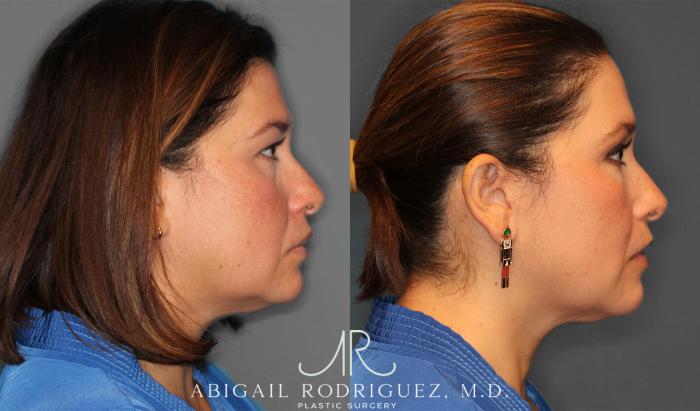 Before & After Upper Eyelid Lift Case 258011 View 6 View in Houston, TX