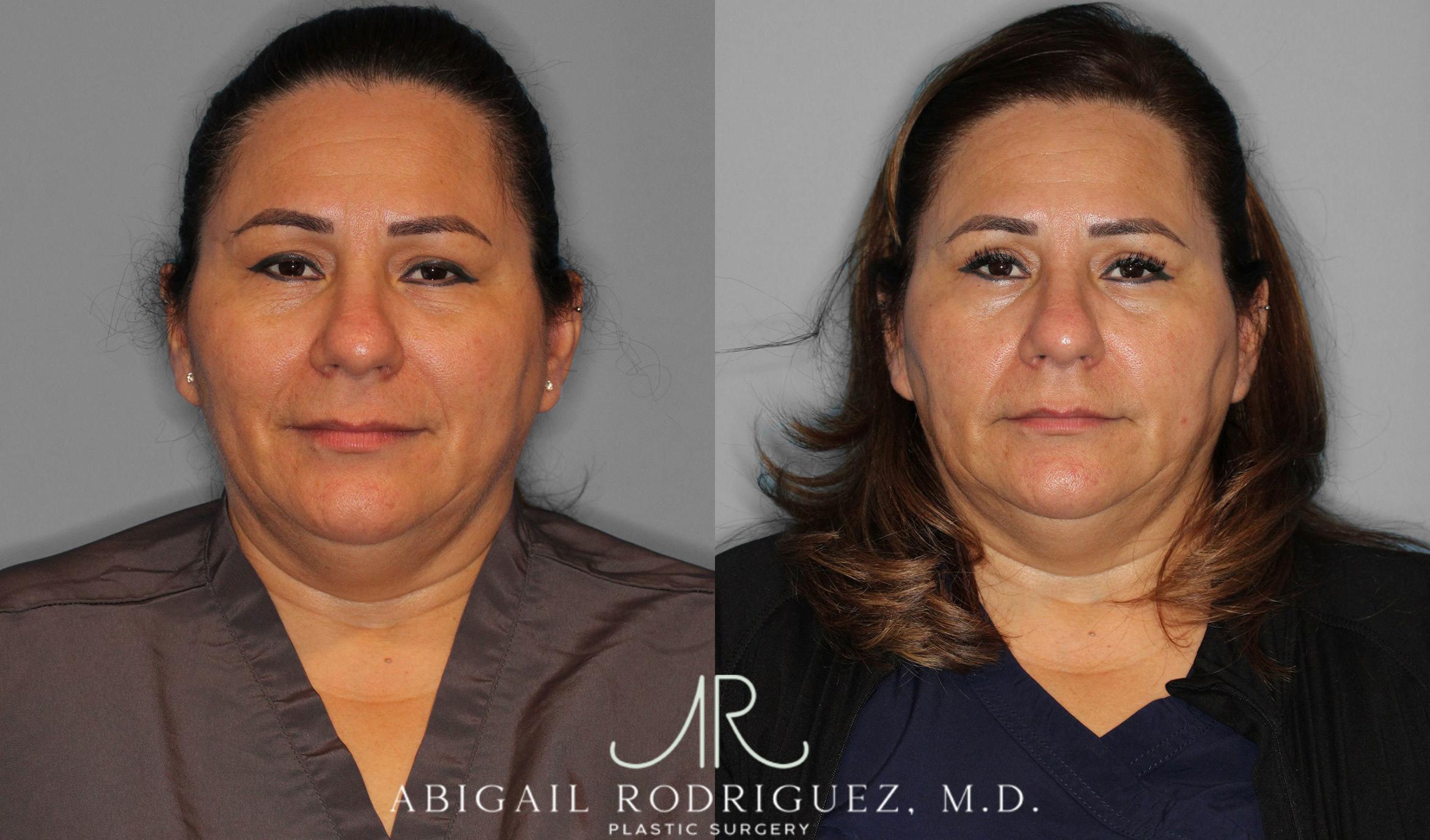 Before & After Upper Eyelid Lift Case 258452 View 1 View in Houston, TX