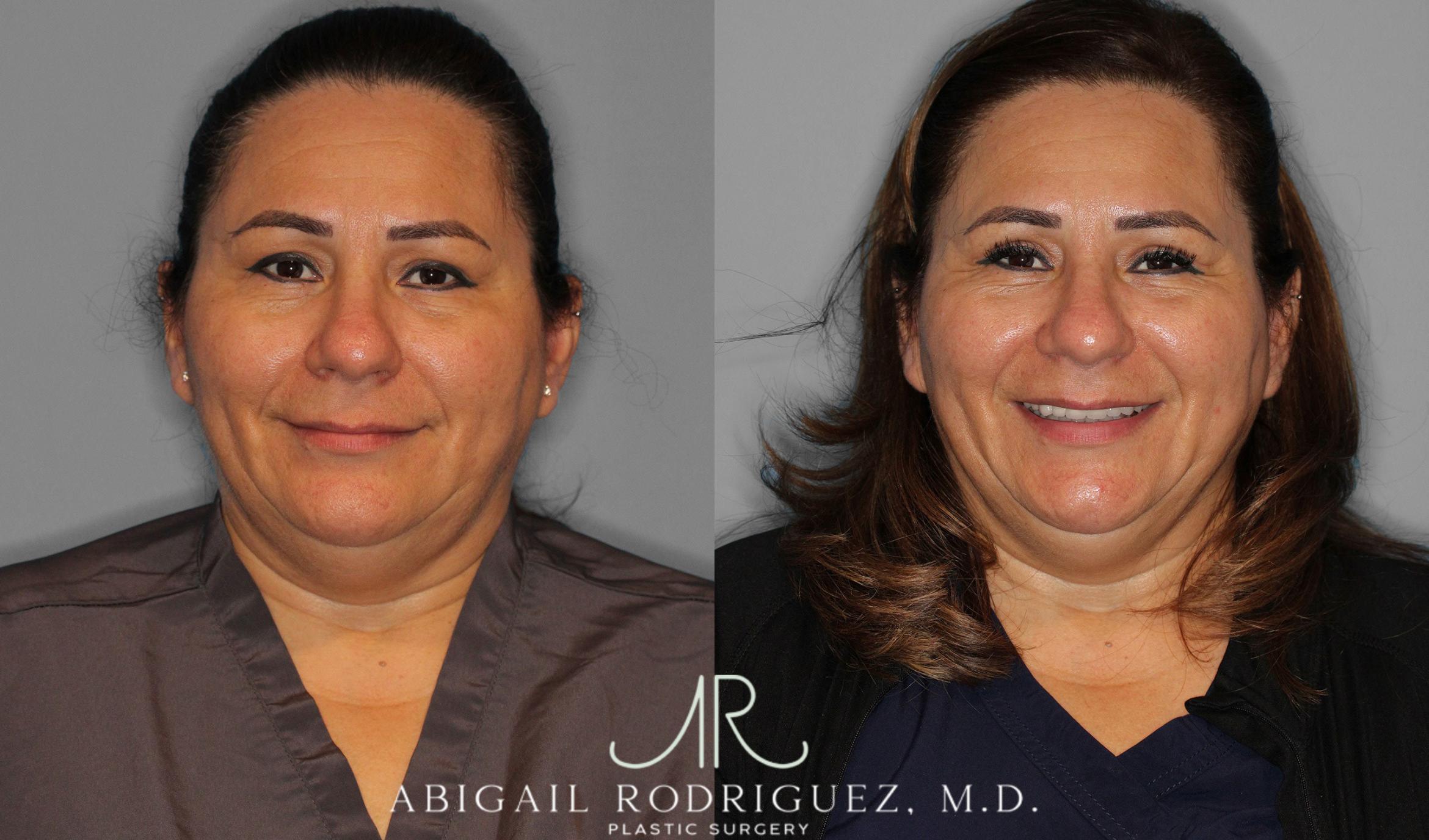 Before & After Upper Eyelid Lift Case 258452 View 2 View in Houston, TX