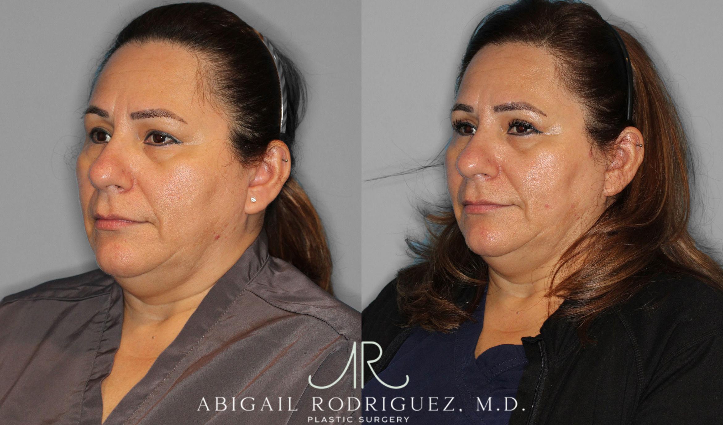 Before & After Upper Eyelid Lift Case 258452 View 3 View in Houston, TX