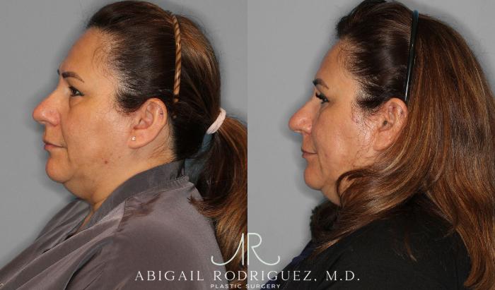 Before & After Upper Eyelid Lift Case 258452 View 4 View in Houston, TX