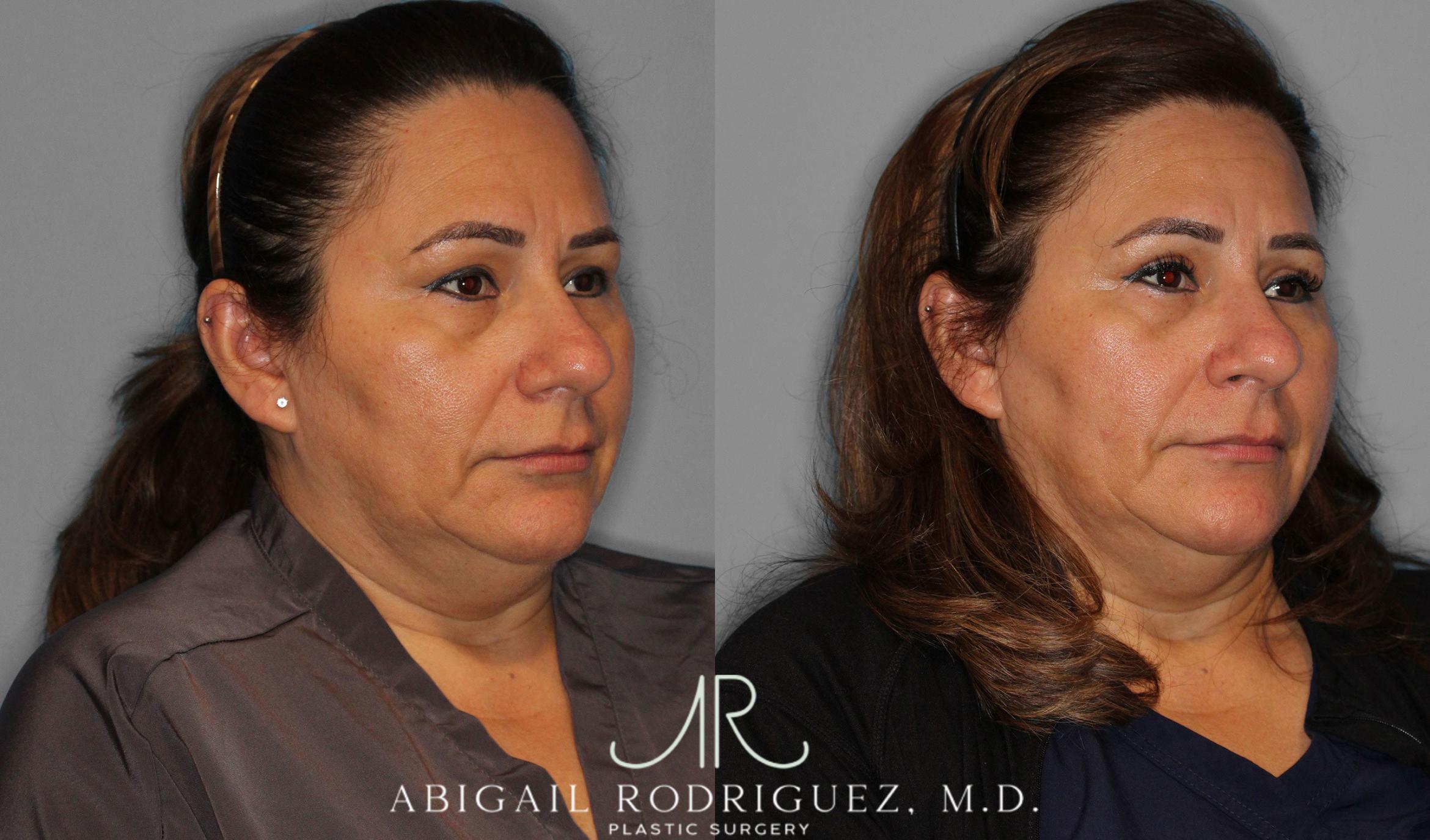 Before & After Upper Eyelid Lift Case 258452 View 5 View in Houston, TX