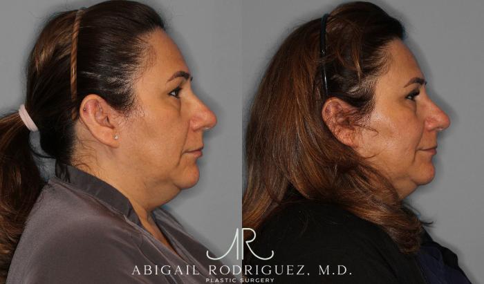 Before & After Upper Eyelid Lift Case 258452 View 6 View in Houston, TX